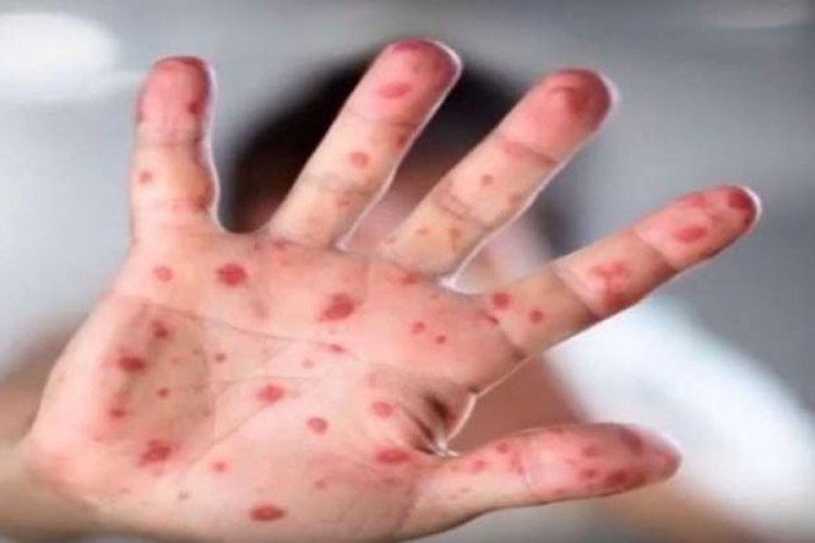 Epidemija morbila u Sarajevu, dvije bebe u teškom stanju