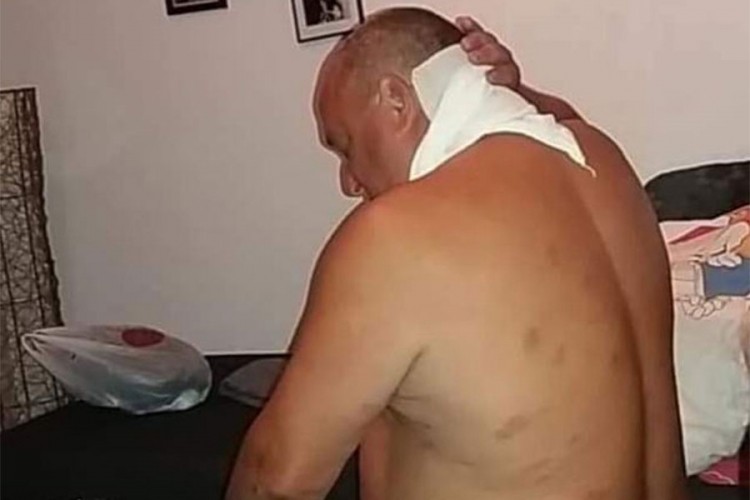 Drvosječa iz Oštre Luke preživio čak 67 uboda stršljenova