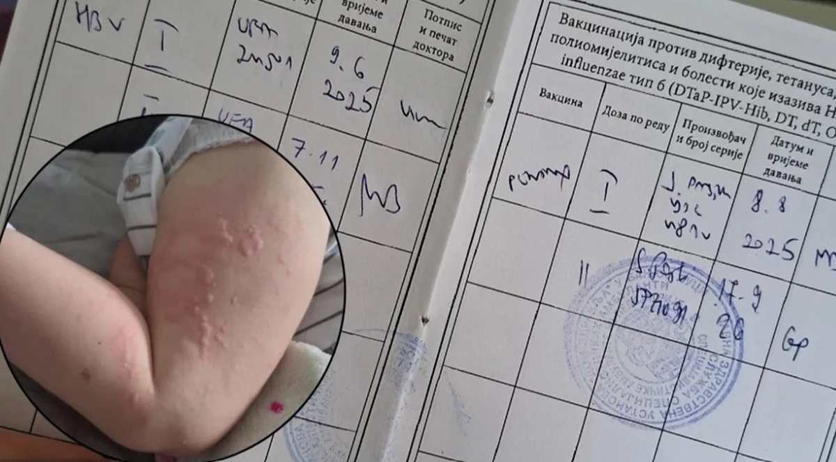 Dječak u Banjaluci primio Pentaxim umjesto vakcine protiv hepatitisa B, tri dana kasnije urtikarija
